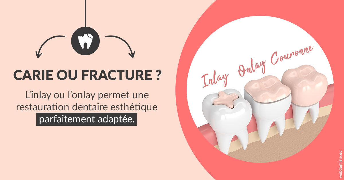 https://dr-fougerais-guillaume.chirurgiens-dentistes.fr/T2 2023 - Carie ou fracture 2