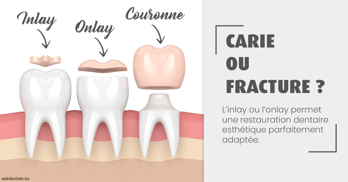 https://dr-fougerais-guillaume.chirurgiens-dentistes.fr/T2 2023 - Carie ou fracture 1