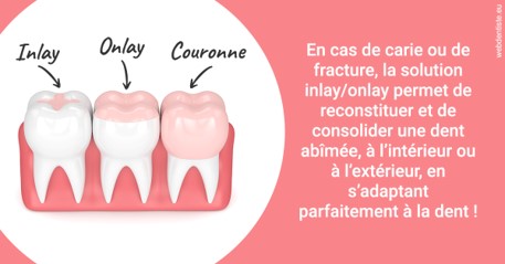 https://dr-fougerais-guillaume.chirurgiens-dentistes.fr/L'INLAY ou l'ONLAY 2