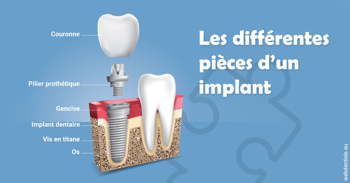 https://dr-fougerais-guillaume.chirurgiens-dentistes.fr/Les différentes pièces d’un implant 1